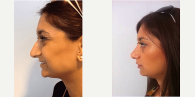Asian Rhinoplasty before and after photo