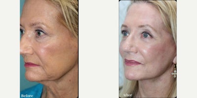 Brow Lift before and after photo