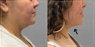 AirSculpt before and after photo