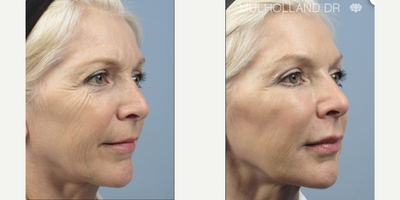 Botox before and after photo