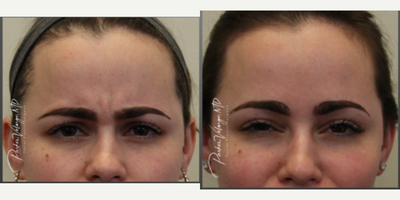 Botox before and after photo