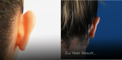 Ear Surgery before and after photo