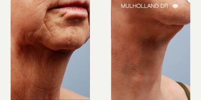 Facelift before and after photo