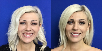Restylane before and after photo