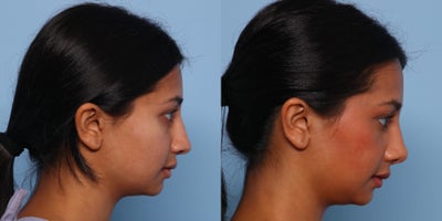 Rhinoplasty before and after photo