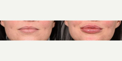 Dermal Fillers before and after photo