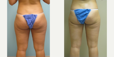 Liposuction before and after photo