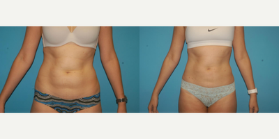 Liposuction before and after photo