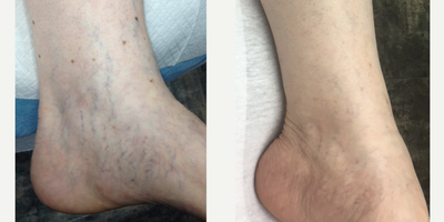 Skin Rejuvenation before and after photo