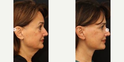 Deep Plane Facelift before and after photo