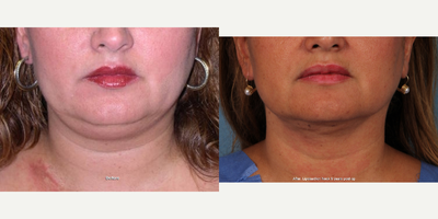 Liposuction before and after photo