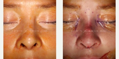 Asian Rhinoplasty before and after photo