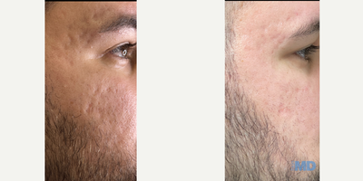 CO2 Laser before and after photo