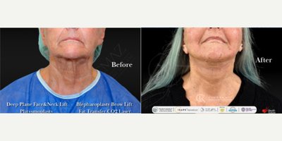 Deep Plane Facelift before and after photo