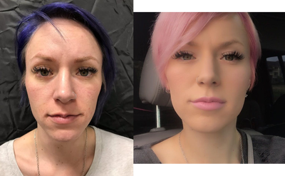 Lip Fillers before and after photo