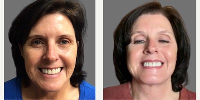 Neck Lift before and after photo