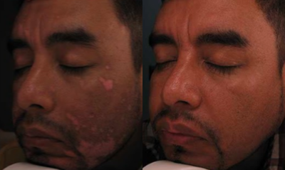 Photodynamic Therapy before and after photo