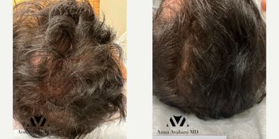 PRP for Hair Loss before and after photo
