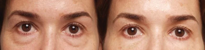 Restylane before and after photo