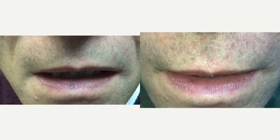 YAG Laser before and after photo