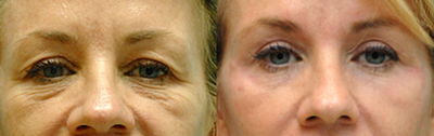 Brow Lift before and after photo