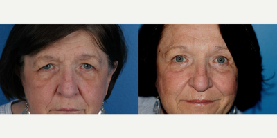 Eyelid Surgery before and after photo