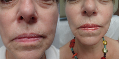 Restylane Lyft before and after photo