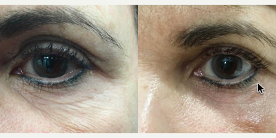 Agnes RF before and after photo