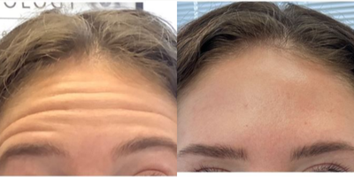 Botox before and after photo