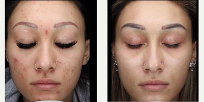 Clear and Brilliant before and after photo