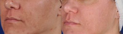 Fraxel Laser before and after photo