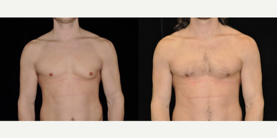 Gynecomastia Surgery before and after photo