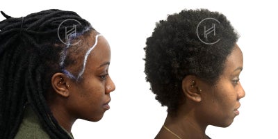 Hair Transplant before and after photo