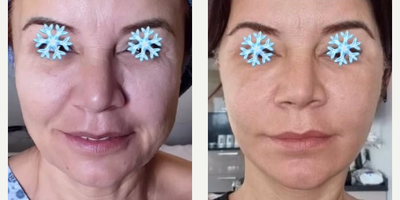 Mini Facelift before and after photo