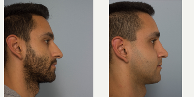 Rhinoplasty before and after photo