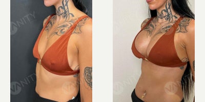 Breast Augmentation before and after photo