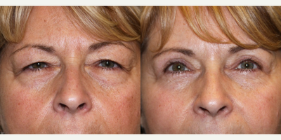 Eyelid Surgery before and after photo