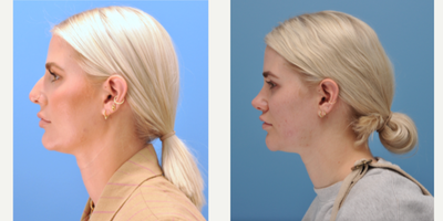 Lip Lift before and after photo