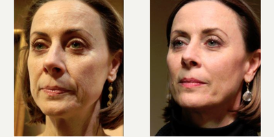 Liquid Facelift before and after photo