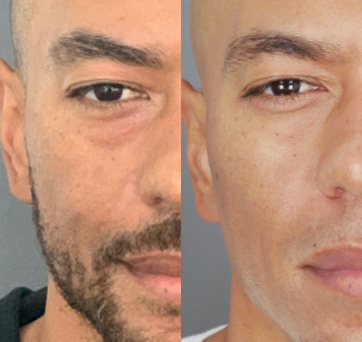 Morpheus8 before and after photo