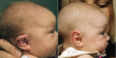 Rhinoplasty before and after photo
