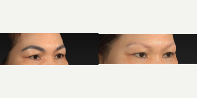 Tattoo Removal before and after photo