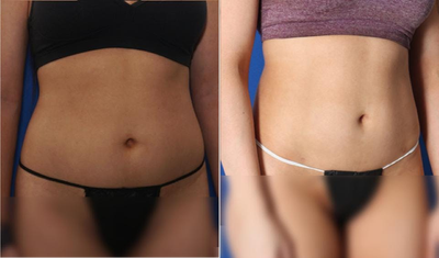 BodyTite before and after photo