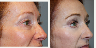 Eyelid Surgery before and after photo