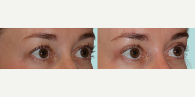 Eyelid Surgery before and after photo