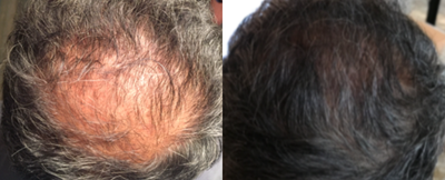 NeoGraft before and after photo