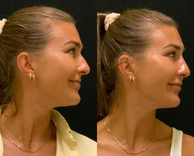 Nonsurgical Nose Job before and after photo