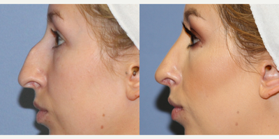 Rhinoplasty before and after photo