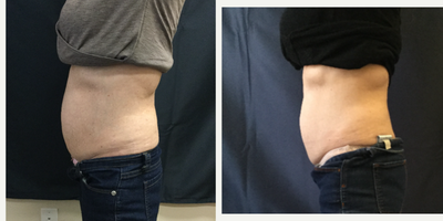 SculpSure before and after photo