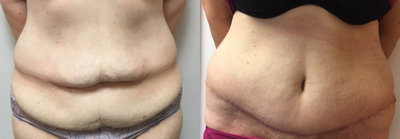 Tummy Tuck before and after photo